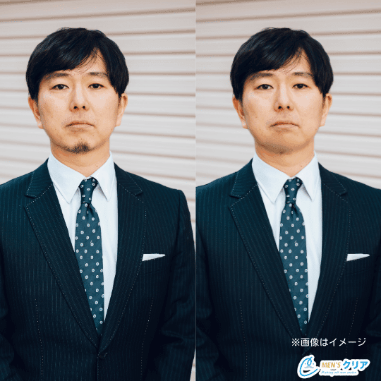 ヒゲ脱毛の経過についてメンズ脱毛サロンRASHINDO横浜鶴見店メンズ脱毛サロンRASHINDO横浜鶴見店