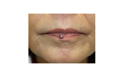 粉瘤以外の皮膚腫瘍１ -血管平滑筋腫- - SSクリニック - 皮膚科・美容外科 - 名古屋市中区