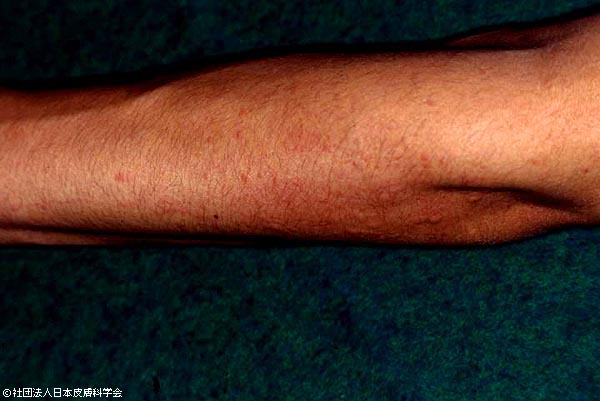 蕁麻疹の写真素材写真素材なら「写真AC」無料 フリー ダウンロードOK