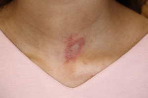 アトピー性皮膚炎