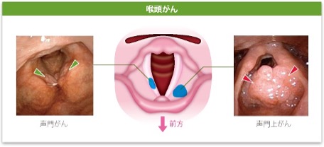 のどちんこの腫れ ① - クリニックブログ - いのうえ耳鼻咽喉科岩倉市の耳鼻咽喉科・小児耳鼻咽喉科・アレルギー科