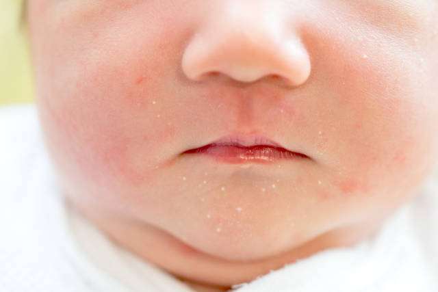 気になる皮膚 赤ちゃんの心と体 ベビーカレンダー専門家相談