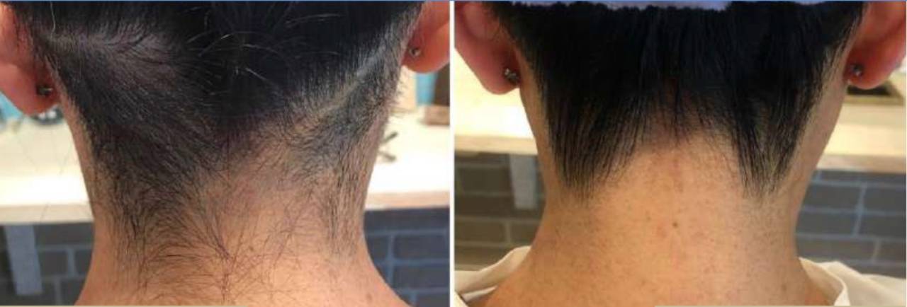 ブラウンシルクエキスパート光美容器 ブラウンの口コミ - 自宅でセルフうなじ脱毛✨ うなじって意外と自然のままは汚いものですね 。 bymomo 混合肌 20代前半LIPS