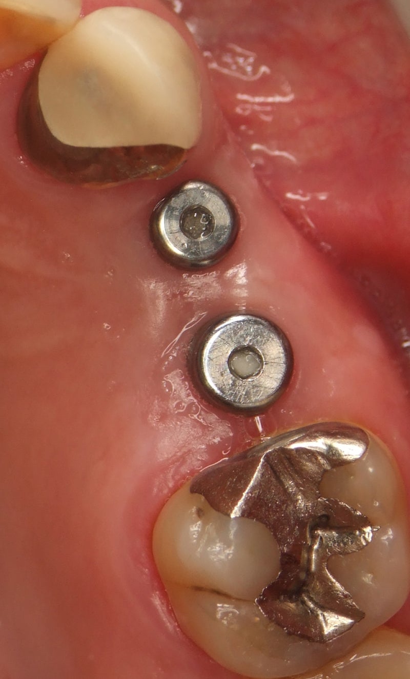 3 複数歯におけるインプラント補綴の印象・注意点