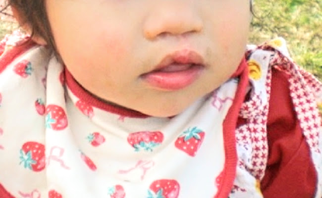 口唇口蓋裂神奈川県立こども医療センタ