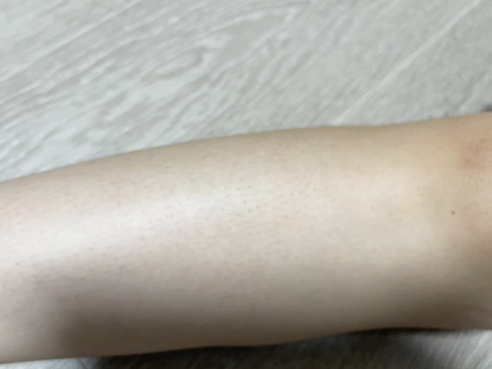 膝のブツブツと黒ずみがやばいです； 画像あり 特にブツブツ・- Yahoo!知恵袋