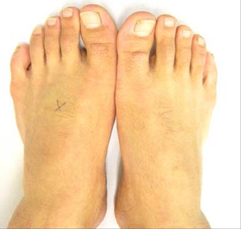 足でよくある症状と病気一般の皆様一般社団法人日本足の外科学会