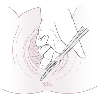 絶対にしたくない！」と思っていた会陰切開。その考えが180度変わった理由ベビーカレンダ