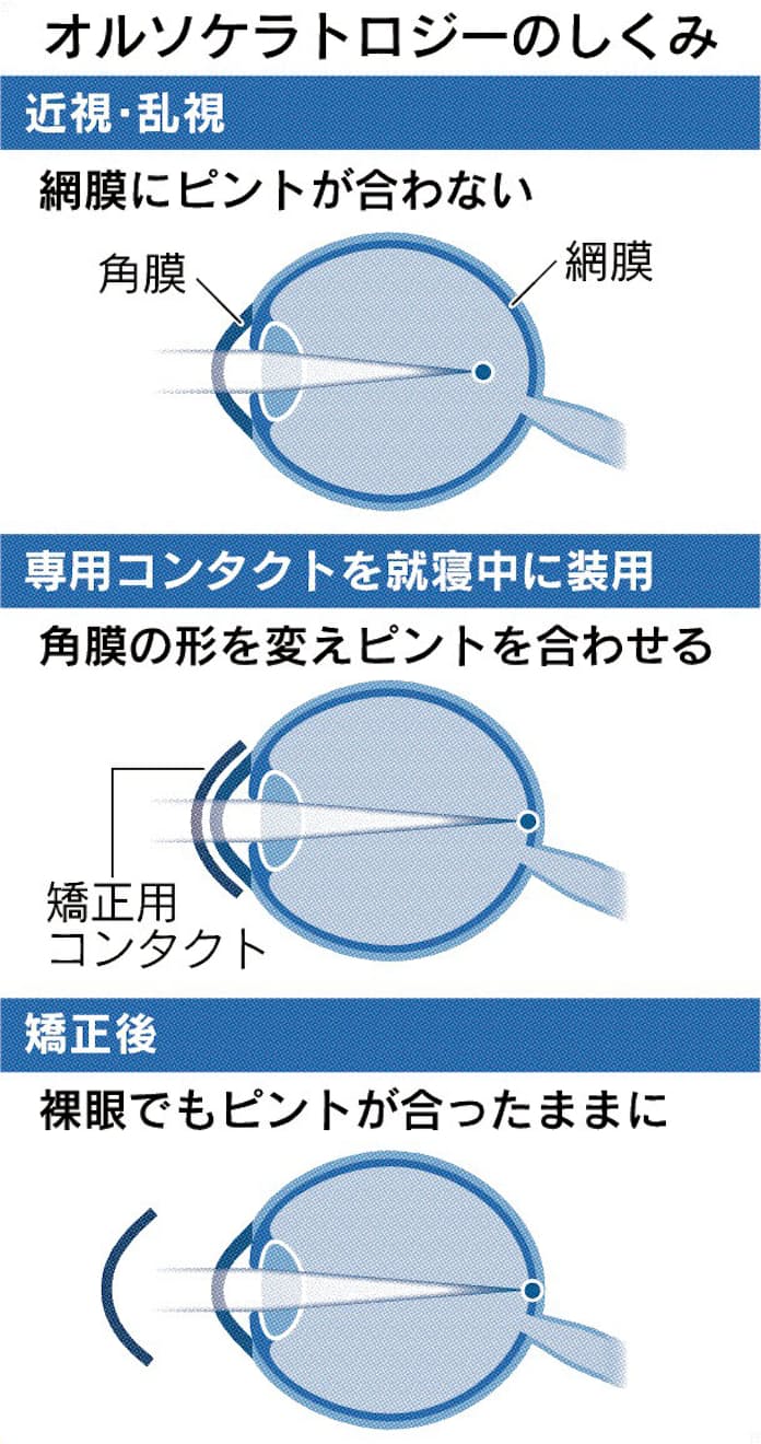 乱視とは?イラストで詳細に解説、乱視チェック - 視力回復ブログ