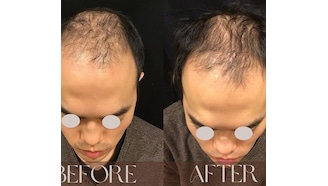 医師監修毛髪再生医療はAGAの救世主となるかDMMオンラインクリニック