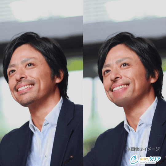 ヒゲ脱毛の副作用やリスクで後悔する理由７選医療機関で脱毛を！初めてのメンズ・ヒゲ脱毛 DATSUO