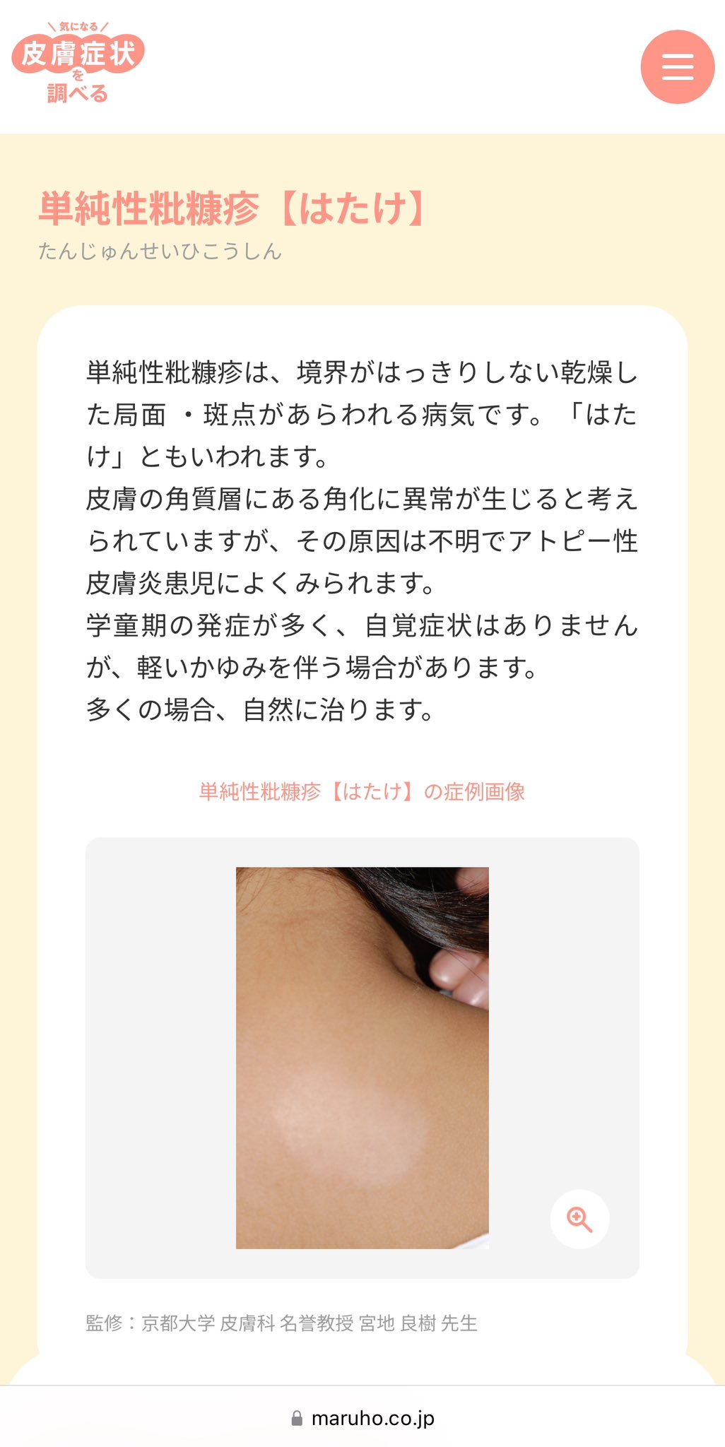 楽しいバーベキューに落とし穴？ 夏に多発のシイタケ皮膚炎トピックス時事メディカル時事通信の医療ニュースサイト