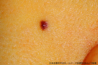 黄あざができる原因は？腕や胸・太ももに身に覚えのないできるあざの対処方法や病気の可能性を解説