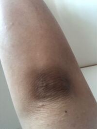 肘の黒ずみ 色素沈着 も綺麗になります💓目黒駅前アキクリニック