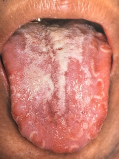 正中菱形舌炎 せいちゅうりょうけいぜつえん 家庭の医学時事メディカル時事通信の医療ニュースサイト