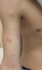 体の片側に症状が現れる 外山望医師提供- 帯状疱疹にご用心「25年間で1.5倍」データも 子育て世代にも広がり -写真・画像 3 4西日本新聞me