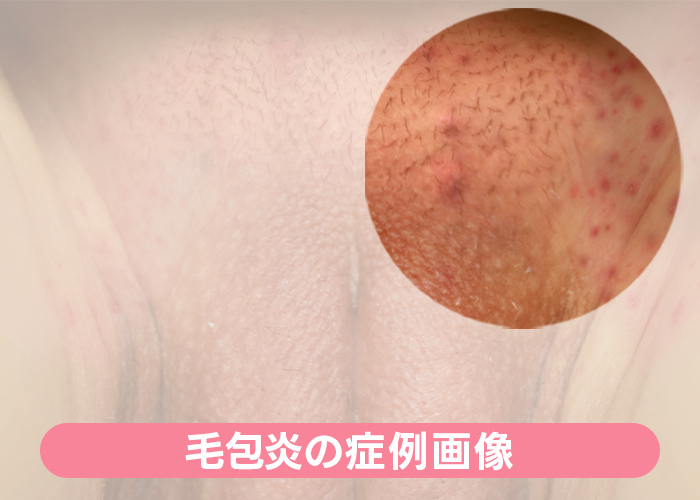 デリケートゾーンの腫れ デキモノ やしこりが痛い！痒い！陰部の違和感の原因、早期受診すべき症状や治療法を女医が丁寧に解説。 –港区、品川区の産婦人科で妊婦健診・産後ケア・避妊相談なら│海老根ウィメンズクリニック