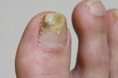 尋常性天疱瘡・水疱性類天疱瘡・疱疹状皮膚炎 ジューリング疱疹状皮膚炎 と甲状腺 長崎甲状腺クリニック