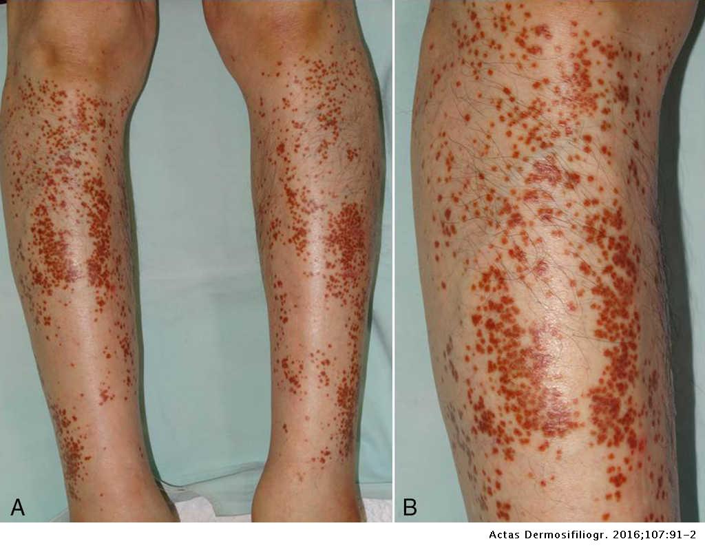 採血の合併症かい内科クリニック大阪狭山市・富田林市・泉ヶ丘