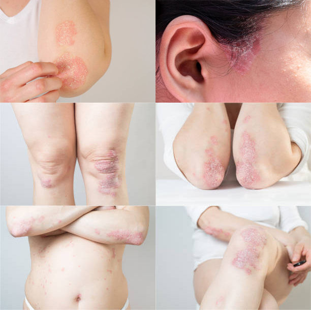 乾癬服部皮膚科アレルギー科岡山市北区清心町の皮膚科・アレルギー科・美容皮膚科