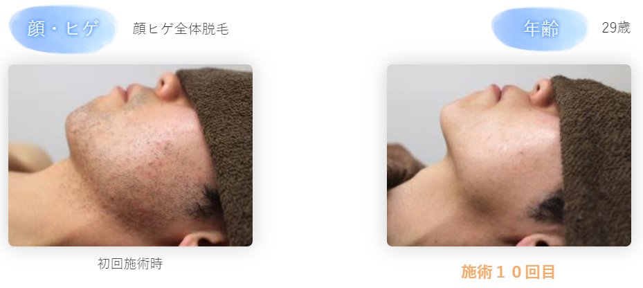 白髪ヒゲを脱毛したい！確実に処理できるおすすめの方法を解説メンズ脱毛百科事典 リンクスペディア