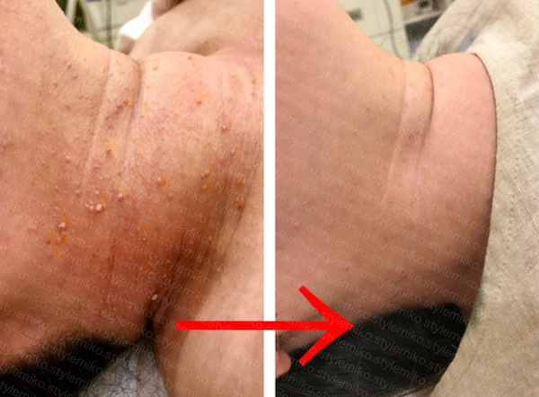 アクロコルドン 首イボ 原因と治療を専門医が解説自由が丘皮膚科