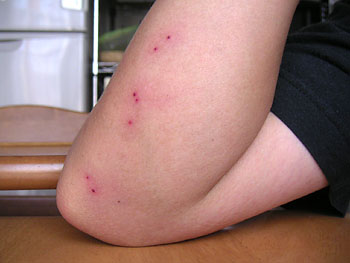 ブヨに刺されたら。知っておきたい症状と対処法とはスキンケア大学