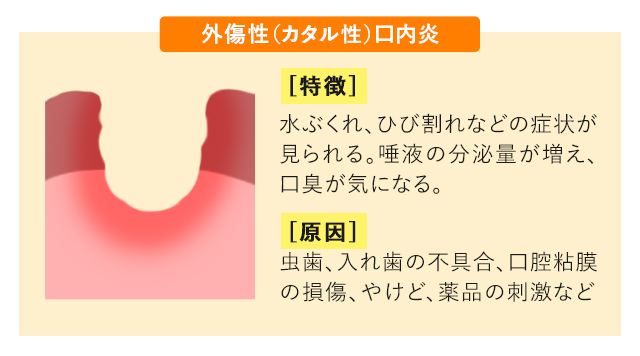 痛いアフタ性口内炎はなぜできるの？どうしたら早く治るの？ - 南22条おとなとこどものクリニック中央区南、幌南小学校前駅・東屯田通駅電停近く、内科・小児科
