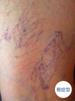 著明な浮腫がみられる患者へのスキンケアスキン 皮膚 トラブルへの対処