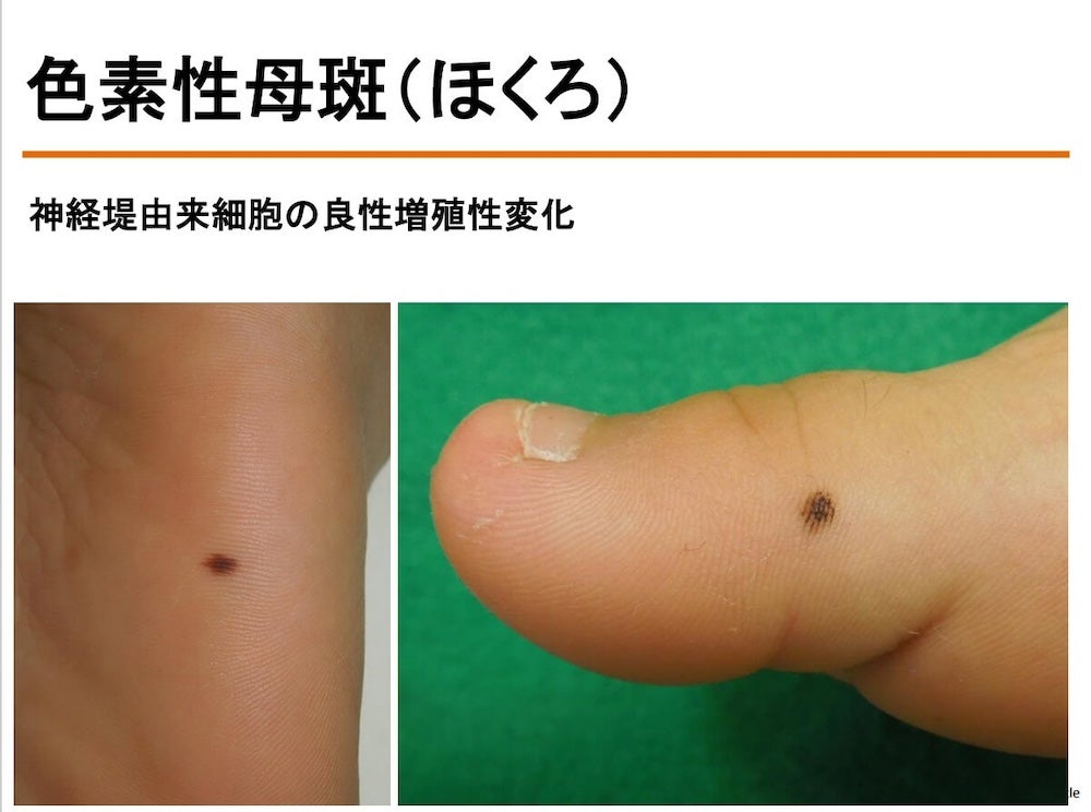 悪性黒色腫 メラノーマ 皮膚腫瘍科がん研有明病院