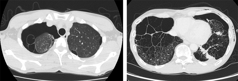 今日の症例・無気肺で肺が縮むということ３: やさしイイ呼吸器教室