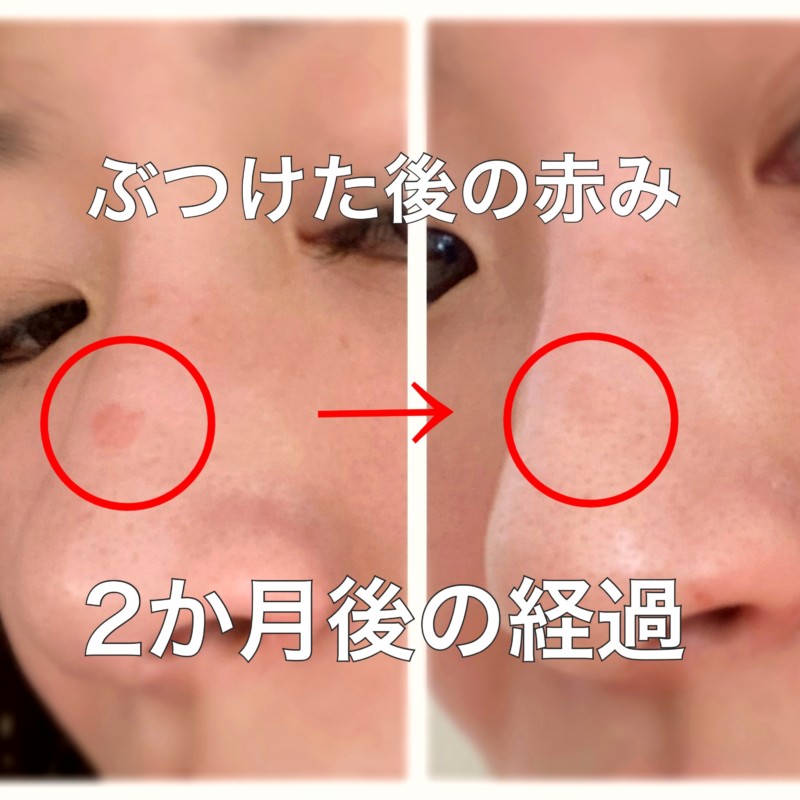 ニキビ跡におすすめの化粧水ランキング2025年最新！プチプラで赤み・色素沈着予防ケア - Beauty produced by au Webポータル