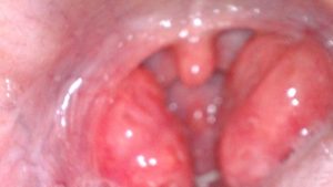 岡山市子どもと扁桃腺 扁桃炎 の関係みやはら耳鼻咽喉科