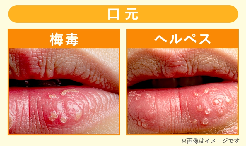 唇のブツブツ：フォアダイスの原因・治し方・予防等について - 美容外科船橋中央クリニック&青山セレスクリニック