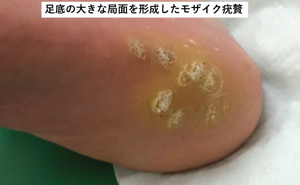 いぼの原因と治療江東区西大島でいぼの診断・治療ができるアリオ北砂皮フ科・アレルギー科