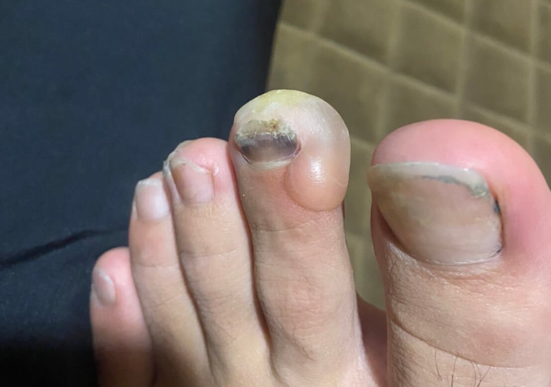 やけど』でできる水ぶくれの対処法は？潰してもいい？治療法を解説田辺三菱製薬ヒフノコトサイト