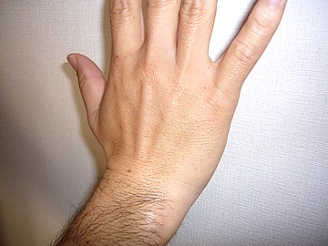 手の甲 毛穴 メンズリゼで手の甲の毛穴が気になるから脱毛してみた！！脱毛二回目でどう変わる？脱毛一回目と比較してみた