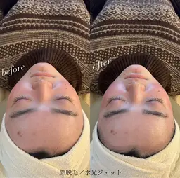 大阪市淀川区で顔脱毛が人気のエステサロンホットペッパービューティ