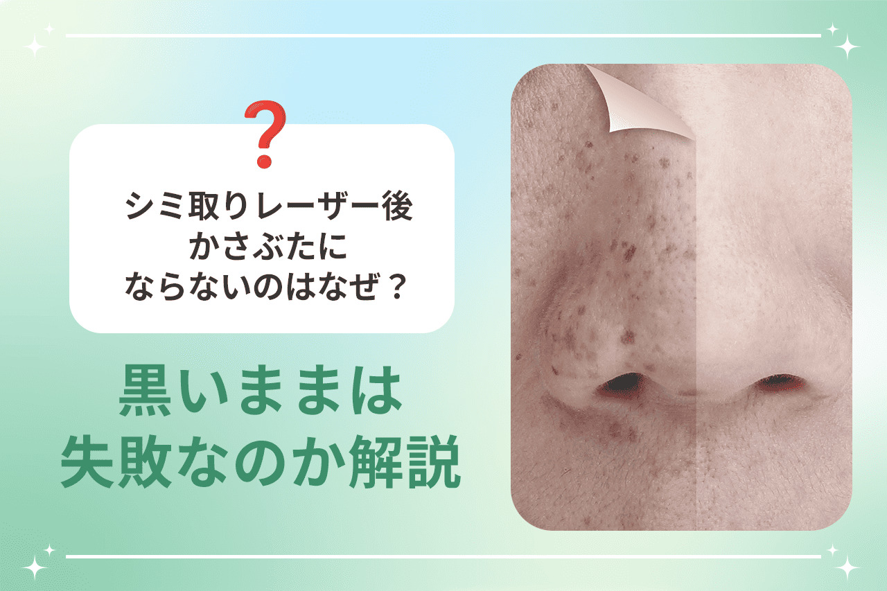 シミ取りレーザーのダウンタイム仕事やメイクは大丈夫？ オジスキンクリニック浦和駅前の美容皮膚科・二重まぶた 肝斑、しみの治療