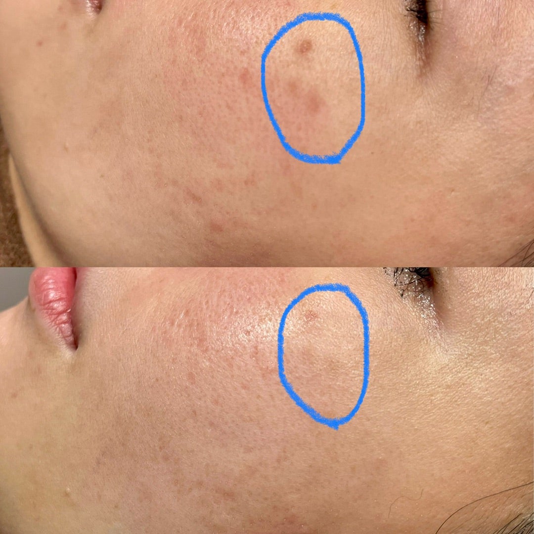 テープ不要のシミ取り ピコレーザーのダウンタイム大公開 のビフォーアフター症例写真 ・画像 THE ROPPONGICLINIC ザロッポンギクリニック
