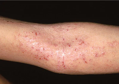 えぬくりブログ: 毛虫皮膚炎とマダニ刺症