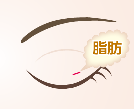 上まぶたの脂肪取り 腫れぼったいまぶたをスッキリ自然な二重に！湘南美容クリニック岡山院がおすすめな理由！ - 岡山院