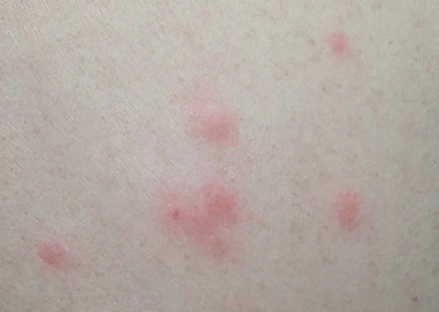 虫刺され高田馬場皮膚科・形成外科