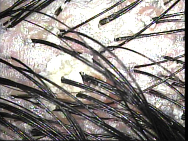 脂漏性皮膚炎錦糸町皮膚科内科クリニック