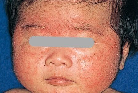 新生児黄疸の写真素材 - PIXTA