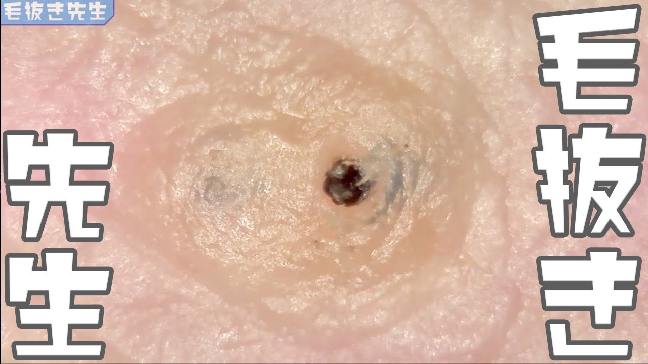 mumuTech 角栓取り 角栓ピンセット 精密 15倍拡大鏡付き 防さび ステンレス製 超精巧 角栓ピンセット ストレート型 プッシャー 拡大鏡