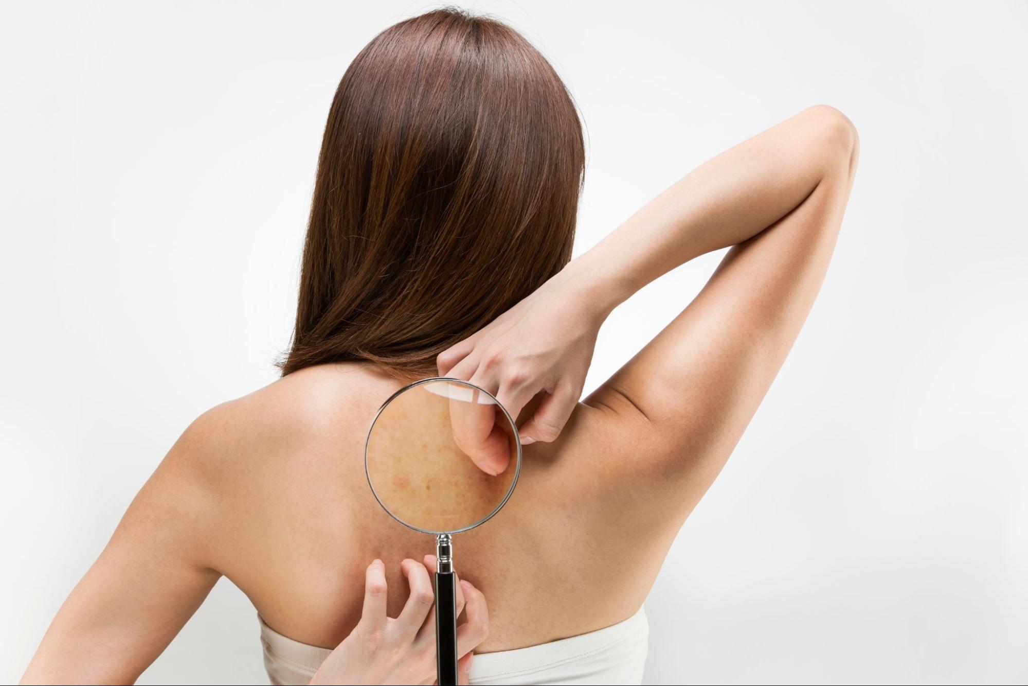 加齢、カビ、それとも ？ おさまらない背中のかゆみの原因と薬の選び方田辺三菱製薬ヒフノコトサイト