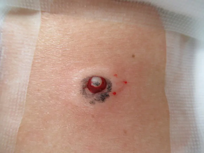 粉瘤大田区大森・大木皮膚科 痛い感染性アテロームの切開対応