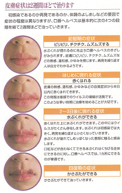 帯状疱疹はうつるの！？帯状疱疹のうつる時期や予防法をご紹介！ - 中村AJペインクリニック