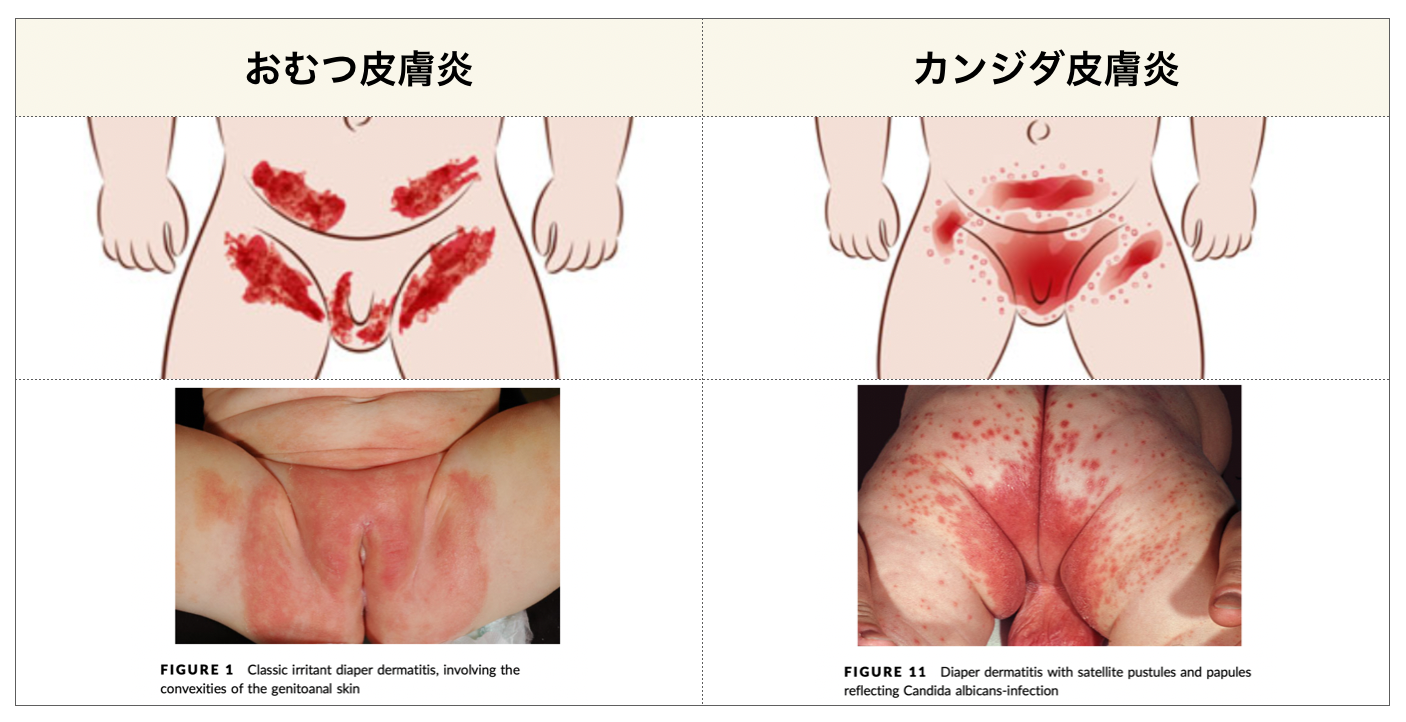 これって間擦疹？それとも ？ : ICU備忘録